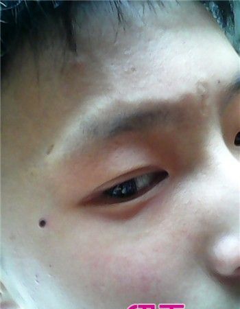 What are the 0 malignant moles on the face that must be removed? Does Lantai Tingwei have moles that bring wealth or destroy it? Picture 4