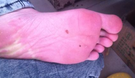 The fate of children with moles on the soles of their feet. What does moles on the soles of their feet mean? Picture 2